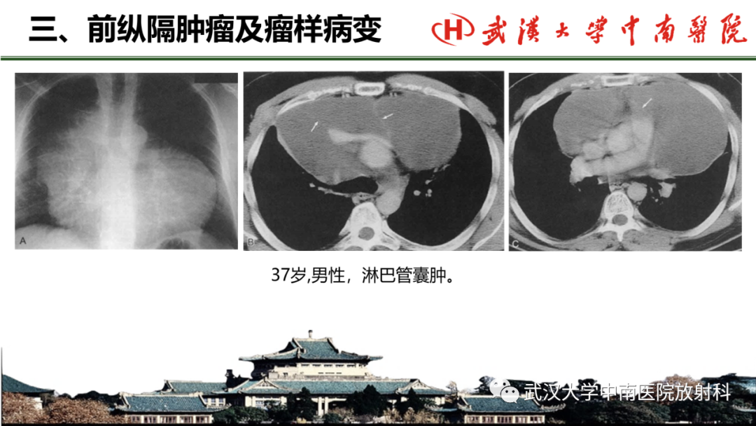 影像PPT - 【PPT】纵隔影像解剖、纵隔肿瘤定位及前纵隔肿瘤和瘤样病变-61