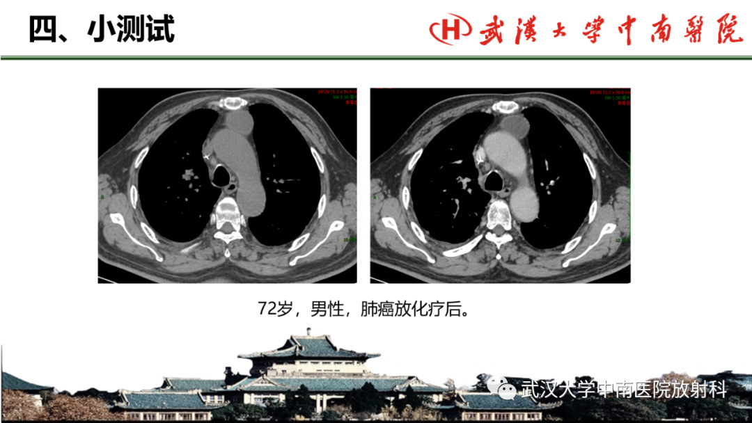 影像PPT - 【PPT】纵隔影像解剖、纵隔肿瘤定位及前纵隔肿瘤和瘤样病变-64