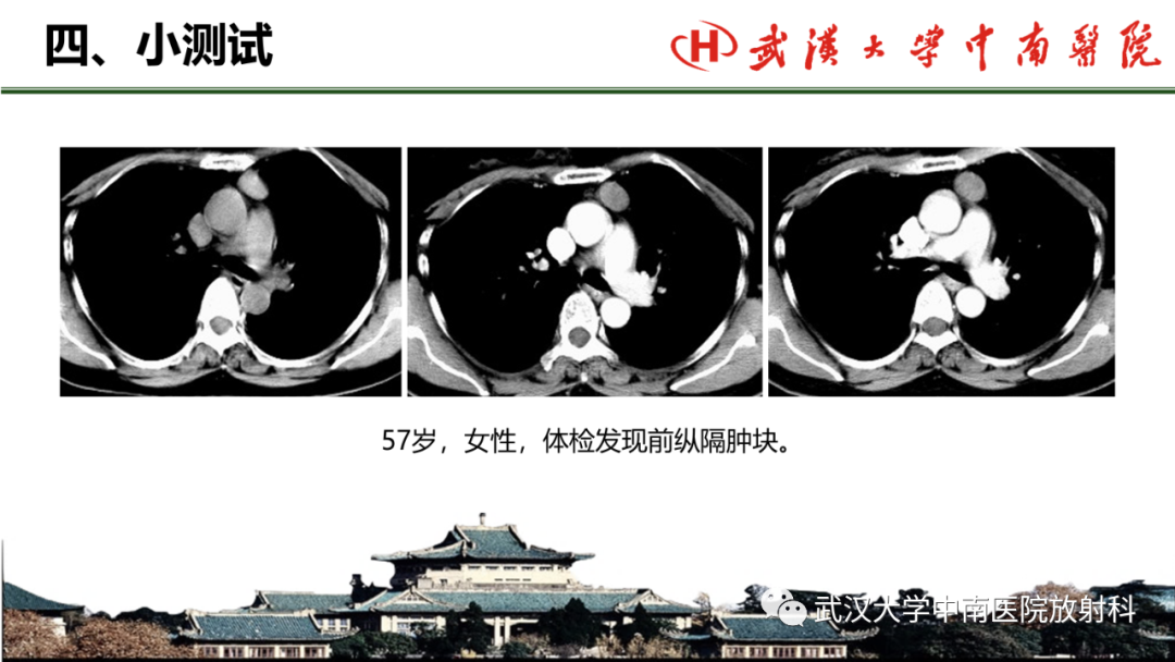 影像PPT - 【PPT】纵隔影像解剖、纵隔肿瘤定位及前纵隔肿瘤和瘤样病变-63