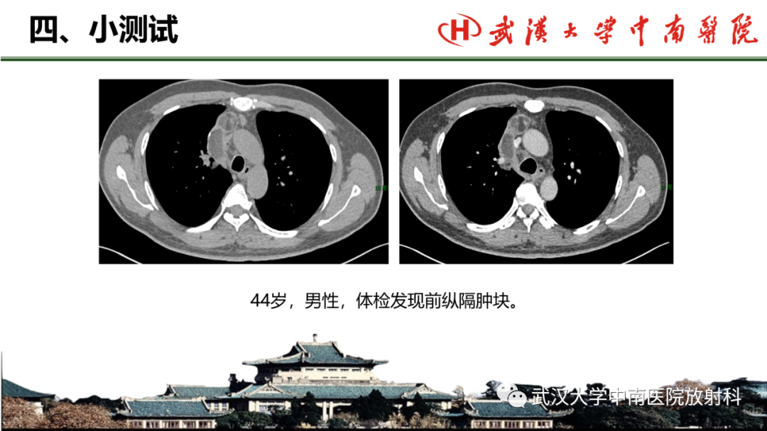 影像PPT - 【PPT】纵隔影像解剖、纵隔肿瘤定位及前纵隔肿瘤和瘤样病变-65