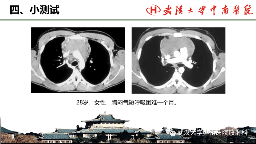 影像PPT - 【PPT】纵隔影像解剖、纵隔肿瘤定位及前纵隔肿瘤和瘤样病变-66