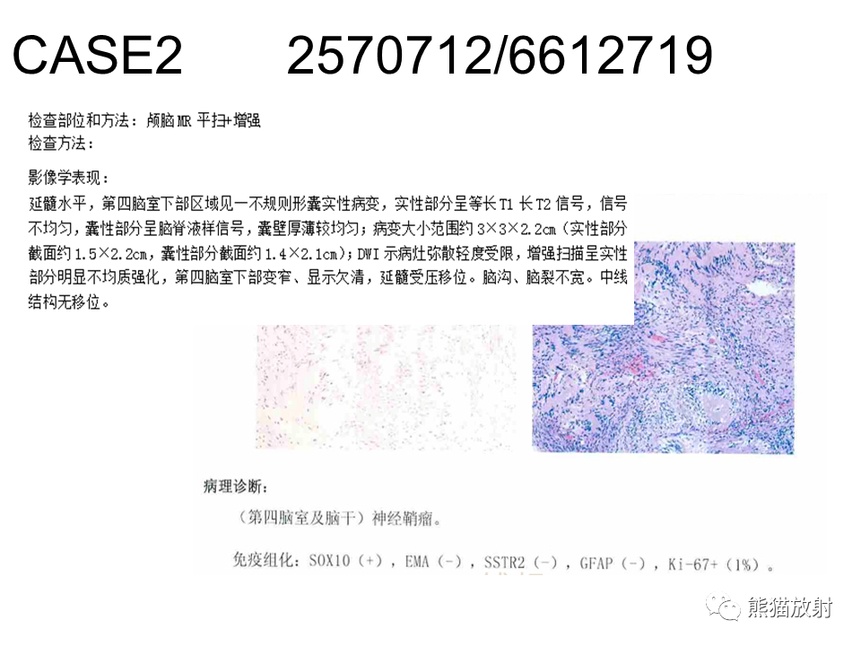影像PPT - 【病例】颅内神经鞘瘤2例MR影像-26
