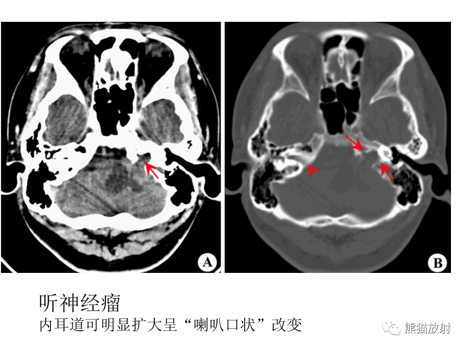 影像PPT - 【病例】颅内神经鞘瘤2例MR影像-35