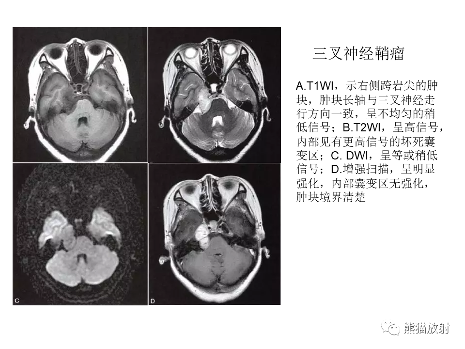 影像PPT - 【病例】颅内神经鞘瘤2例MR影像-37