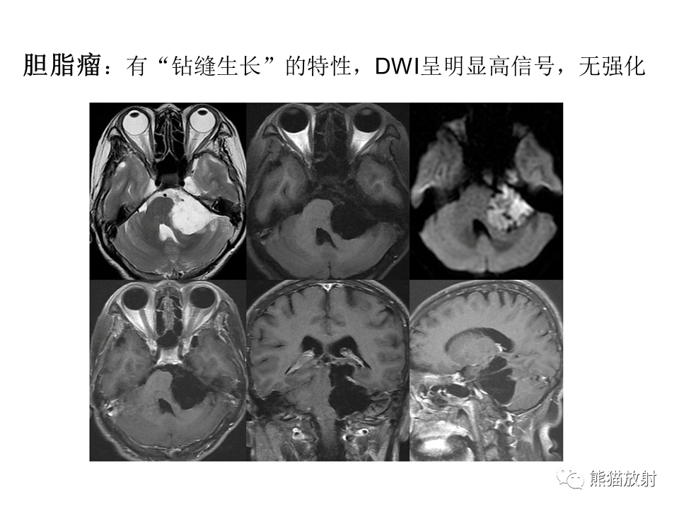 影像PPT - 【病例】颅内神经鞘瘤2例MR影像-40