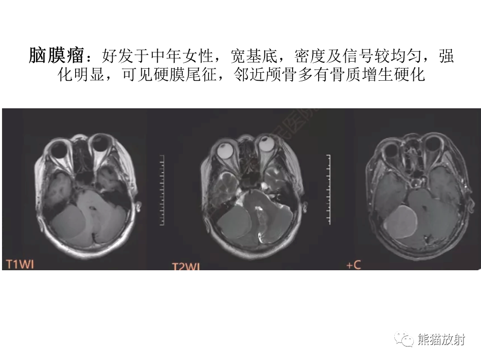 影像PPT - 【病例】颅内神经鞘瘤2例MR影像-39