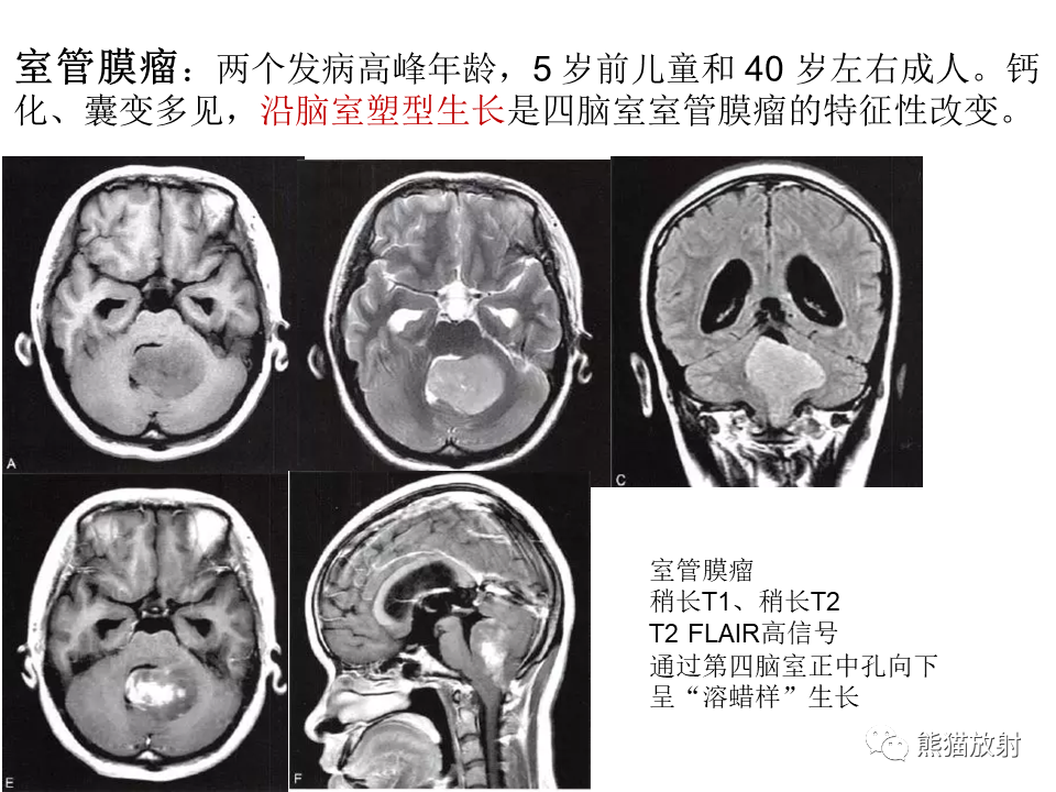 影像PPT - 【病例】颅内神经鞘瘤2例MR影像-43