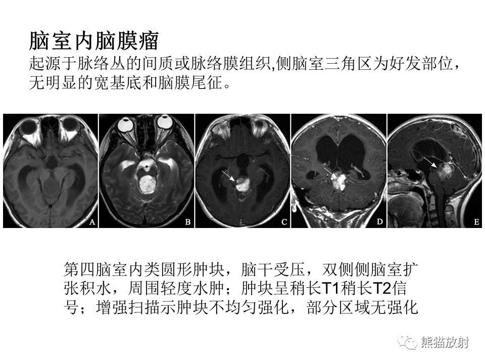 影像PPT - 【病例】颅内神经鞘瘤2例MR影像-45