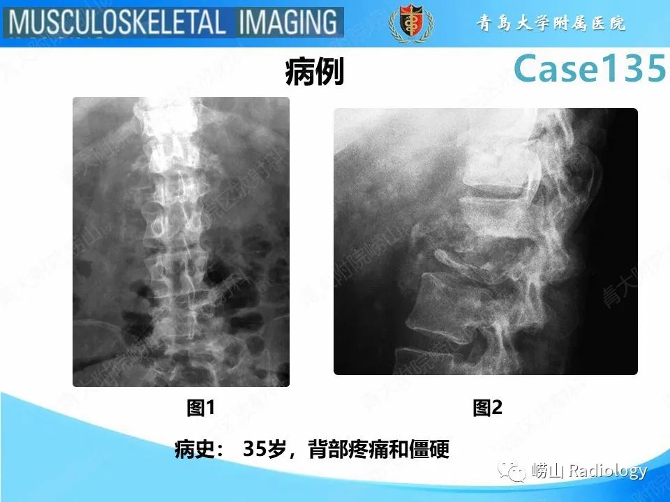 影像PPT - 【PPT】脊柱结核-2