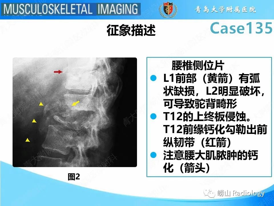 影像PPT - 【PPT】脊柱结核-12