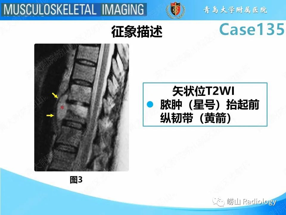 影像PPT - 【PPT】脊柱结核-13