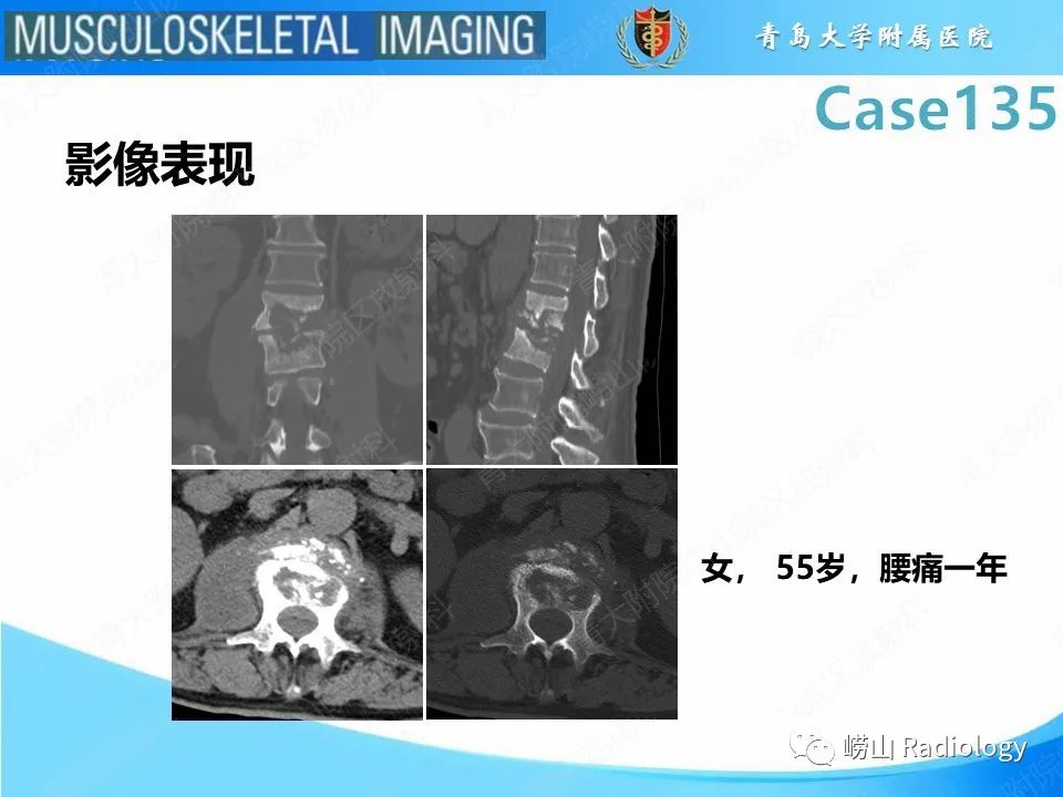 影像PPT - 【PPT】脊柱结核-21