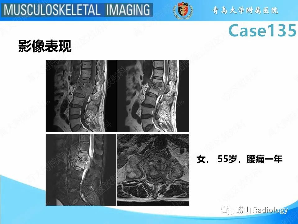 影像PPT - 【PPT】脊柱结核-22