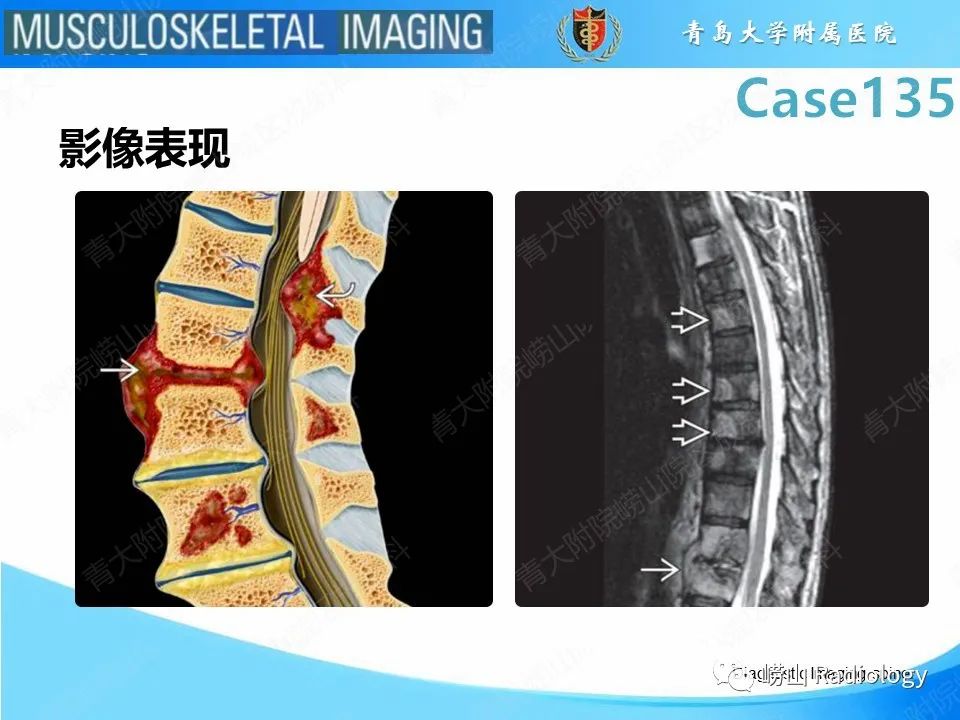 影像PPT - 【PPT】脊柱结核-20