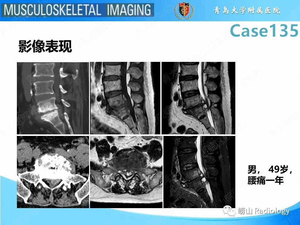 影像PPT - 【PPT】脊柱结核-27