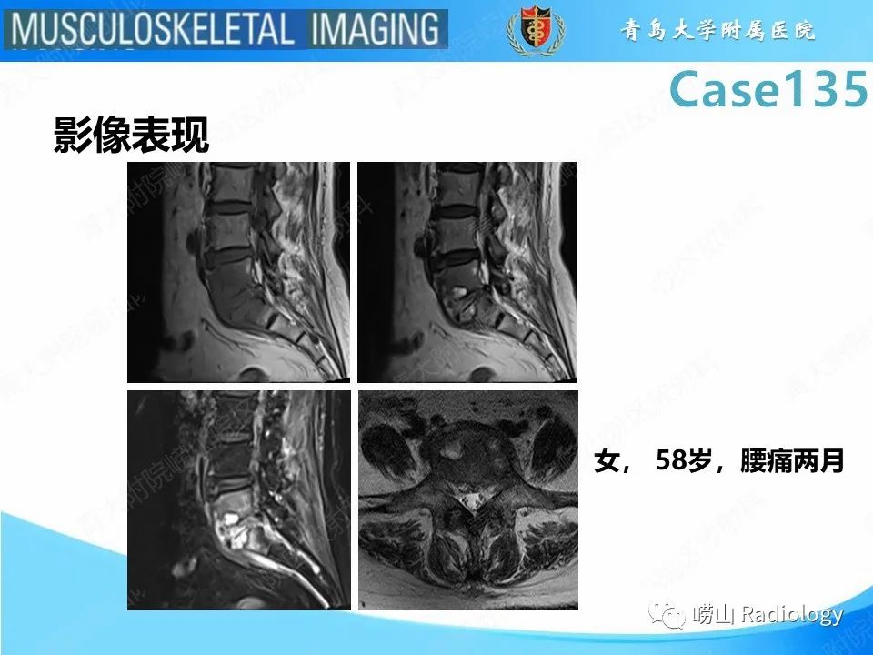 影像PPT - 【PPT】脊柱结核-25