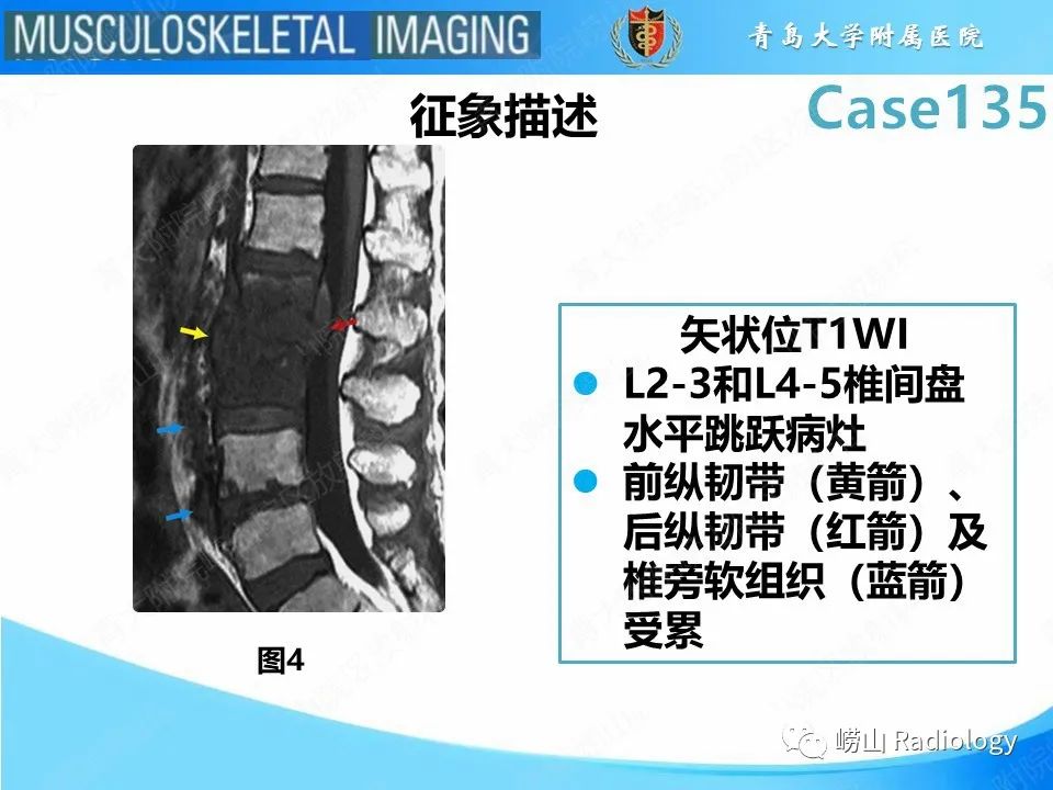 影像PPT - 【PPT】脊柱结核-6