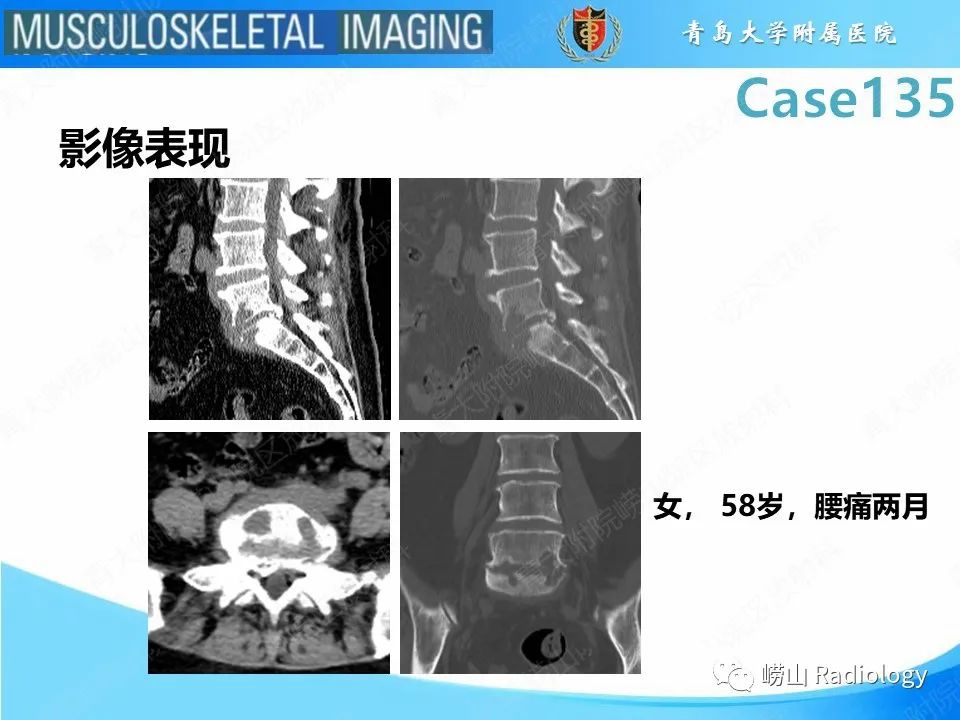 影像PPT - 【PPT】脊柱结核-8