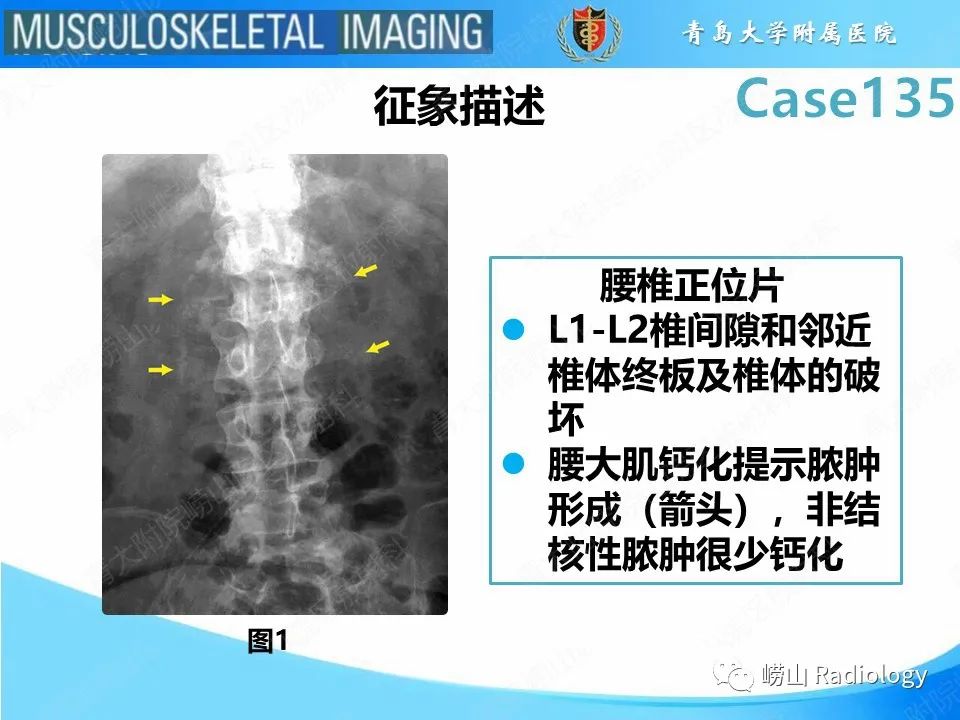 影像PPT - 【PPT】脊柱结核-1