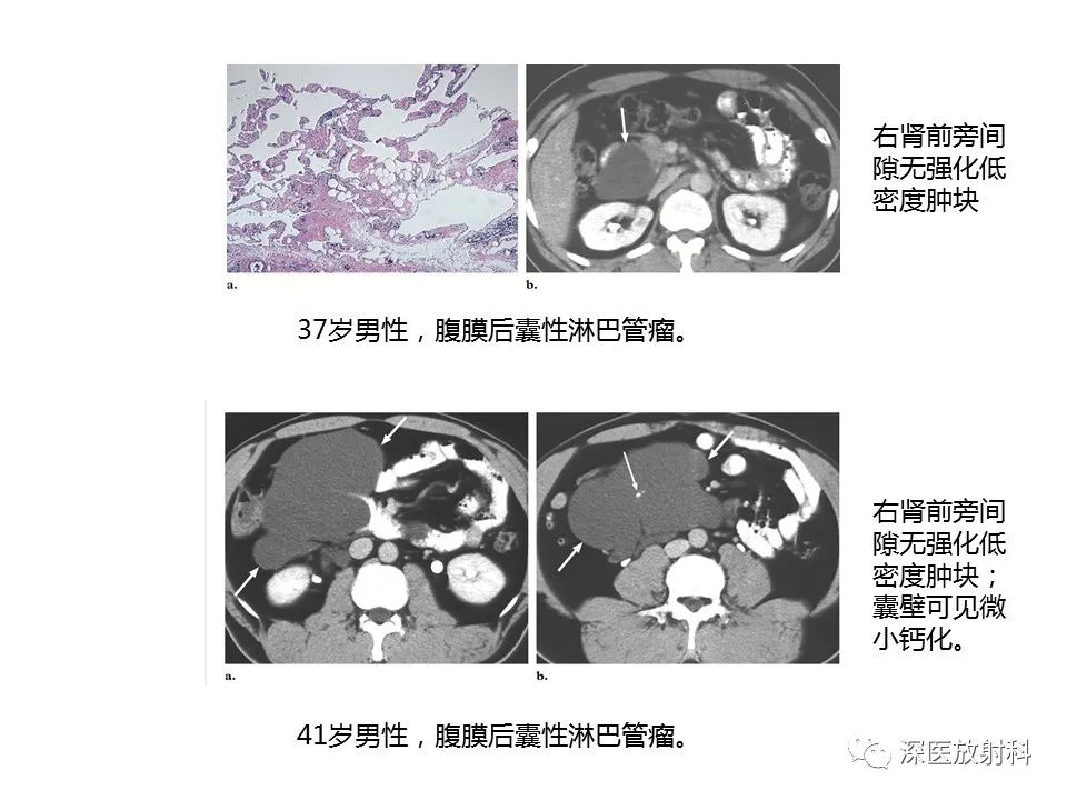影像PPT - 【PPT】原发性腹膜后囊性病变影像学特征-6