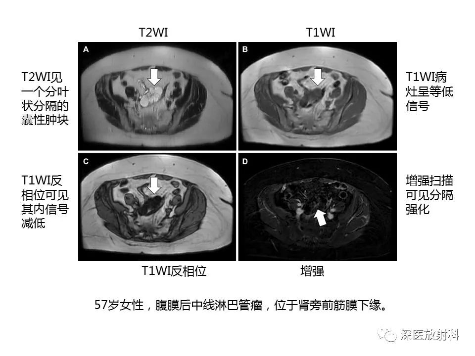 影像PPT - 【PPT】原发性腹膜后囊性病变影像学特征-7