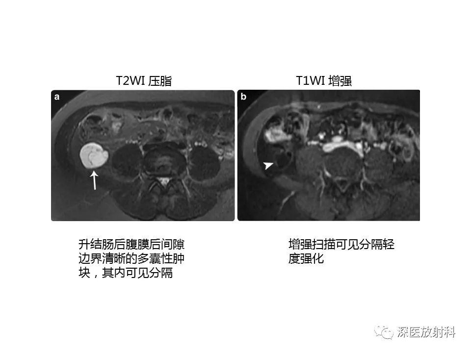 影像PPT - 【PPT】原发性腹膜后囊性病变影像学特征-10