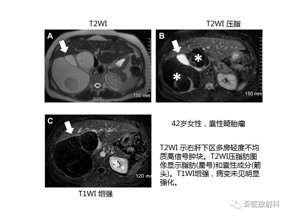 影像PPT - 【PPT】原发性腹膜后囊性病变影像学特征-12