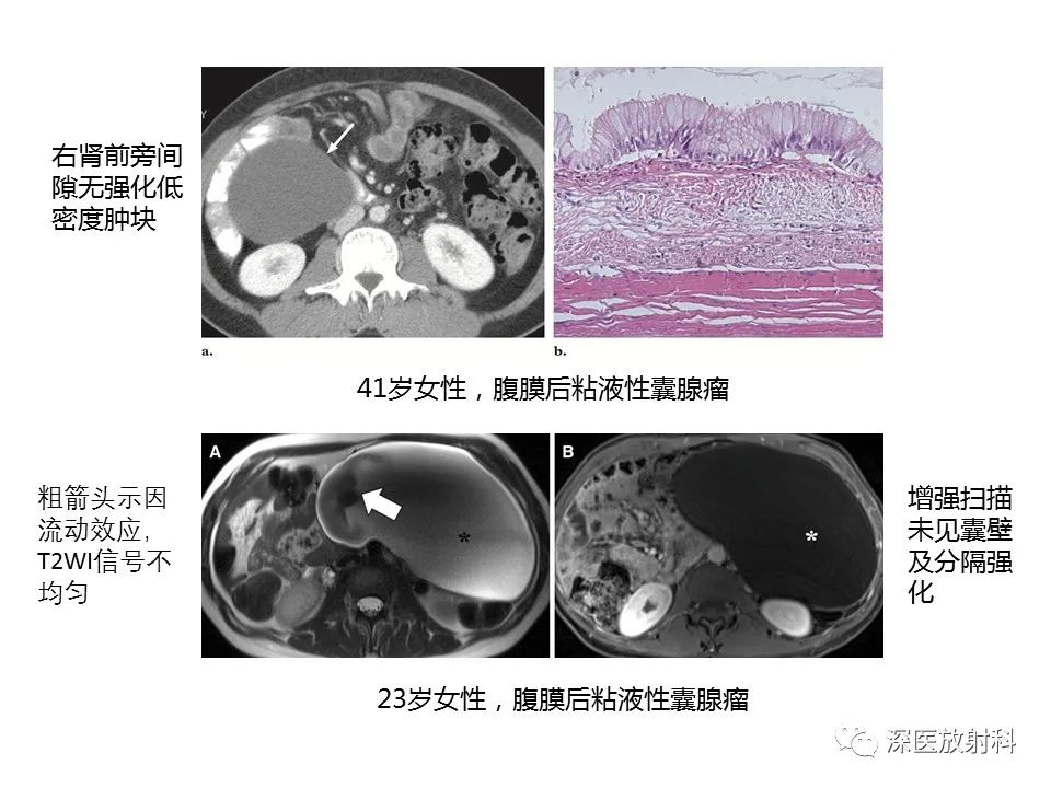 影像PPT - 【PPT】原发性腹膜后囊性病变影像学特征-9