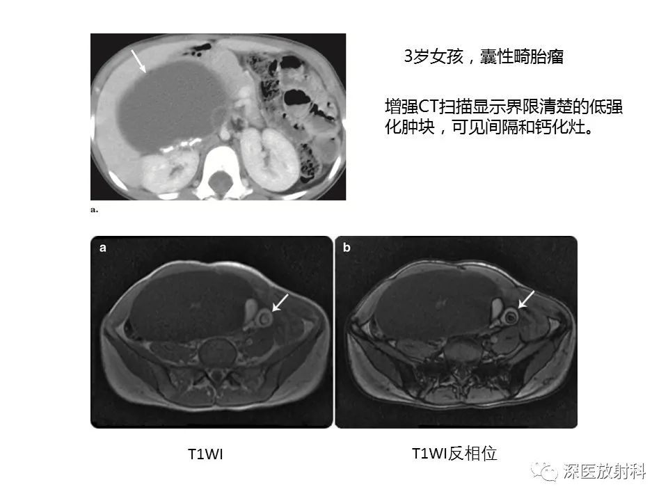 影像PPT - 【PPT】原发性腹膜后囊性病变影像学特征-13