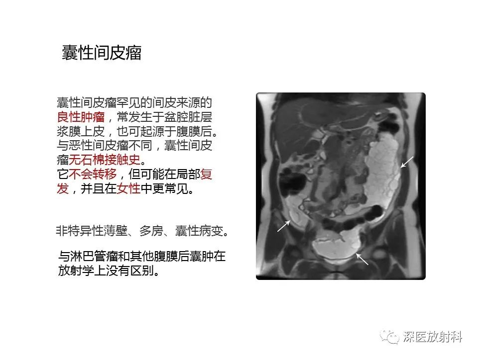 影像PPT - 【PPT】原发性腹膜后囊性病变影像学特征-14