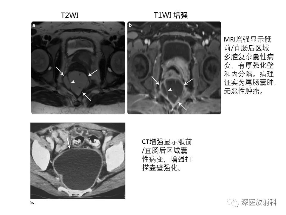 影像PPT - 【PPT】原发性腹膜后囊性病变影像学特征-16