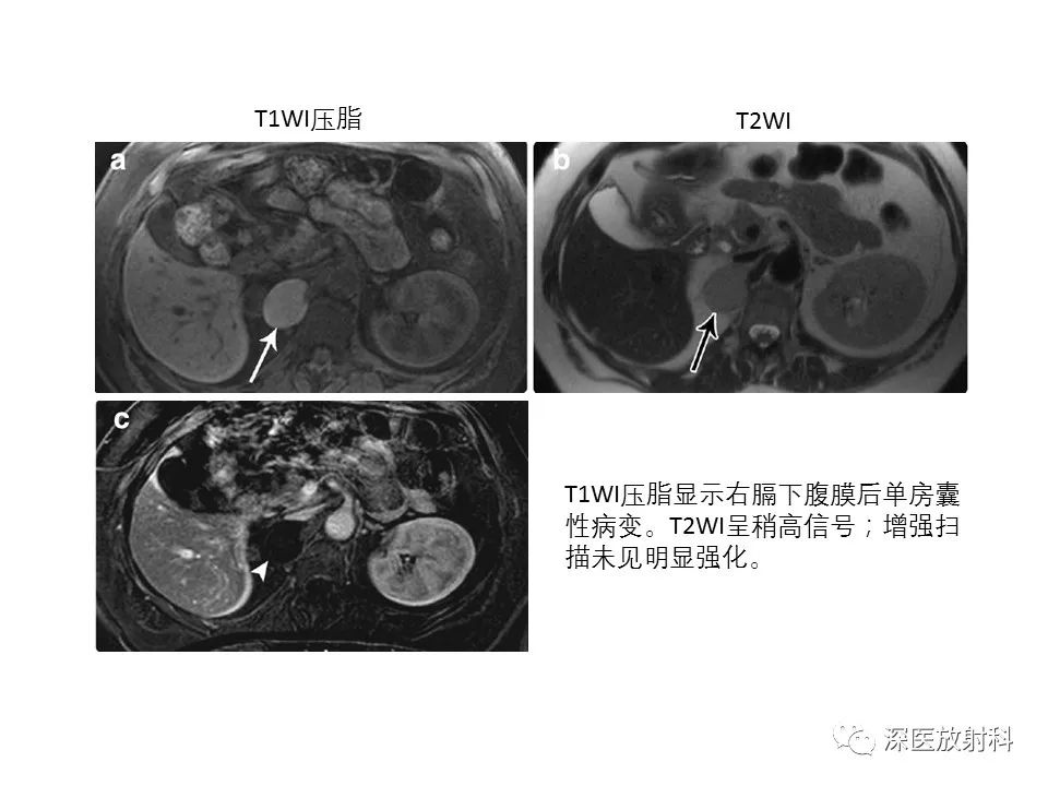 影像PPT - 【PPT】原发性腹膜后囊性病变影像学特征-18