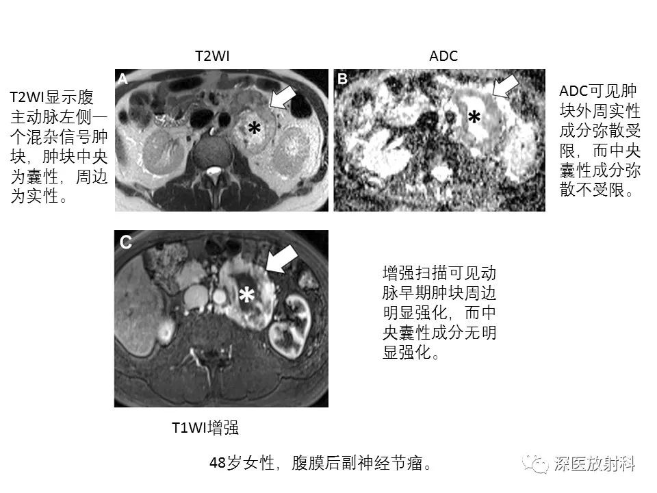 影像PPT - 【PPT】原发性腹膜后囊性病变影像学特征-21