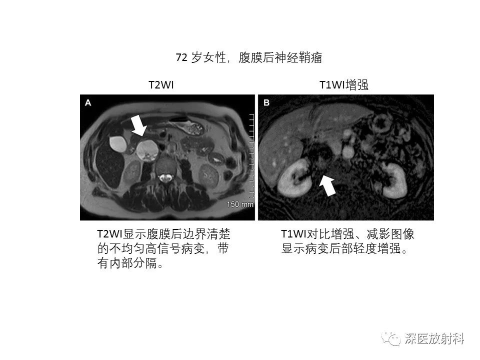 影像PPT - 【PPT】原发性腹膜后囊性病变影像学特征-23