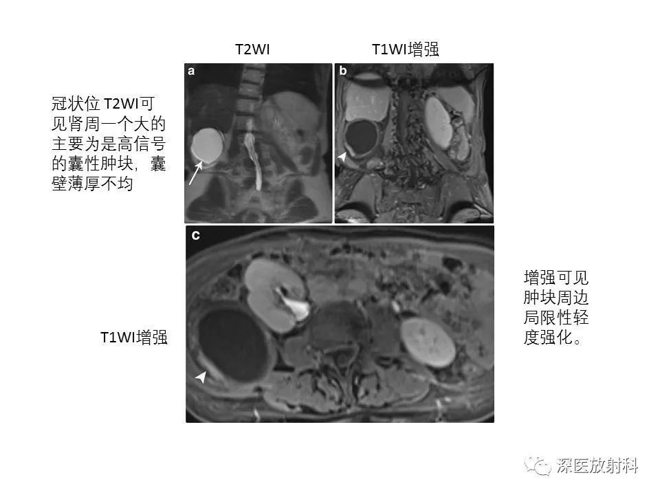 影像PPT - 【PPT】原发性腹膜后囊性病变影像学特征-24