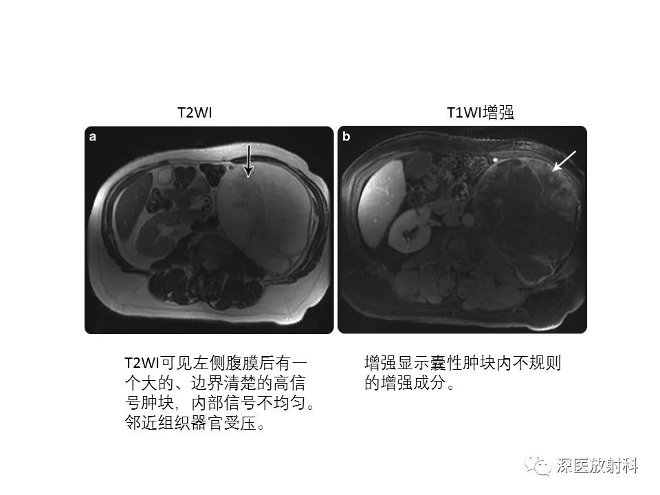 影像PPT - 【PPT】原发性腹膜后囊性病变影像学特征-26