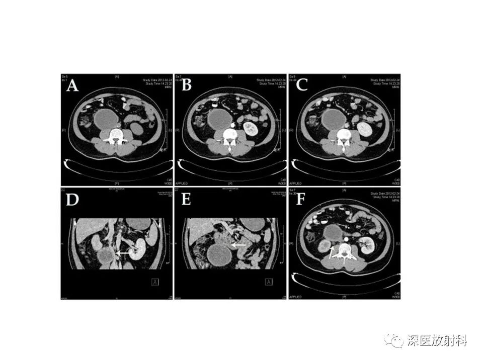 影像PPT - 【PPT】原发性腹膜后囊性病变影像学特征-28