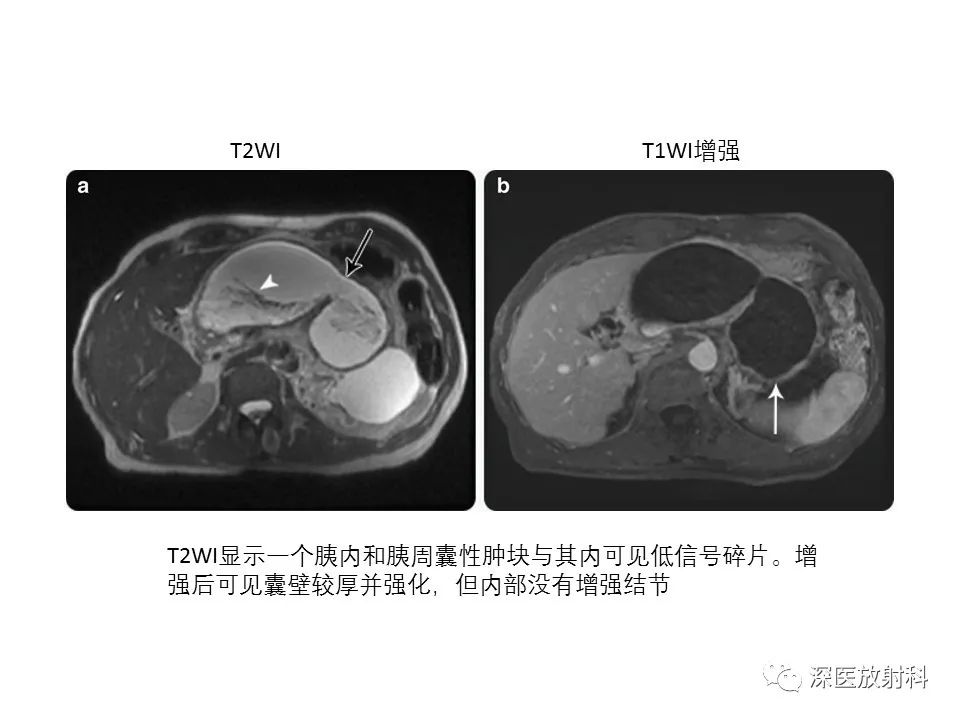 影像PPT - 【PPT】原发性腹膜后囊性病变影像学特征-30