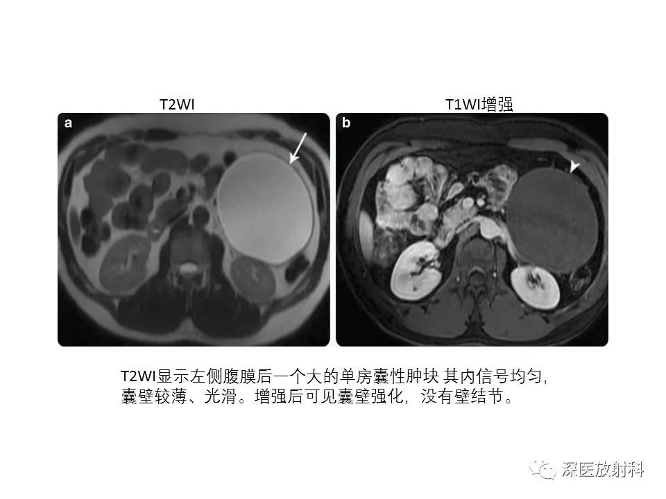 影像PPT - 【PPT】原发性腹膜后囊性病变影像学特征-32