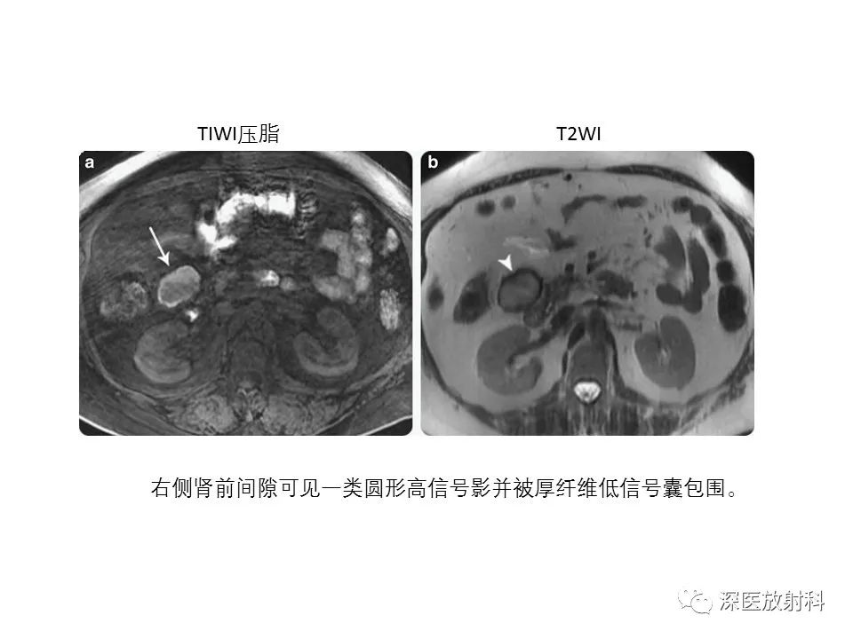影像PPT - 【PPT】原发性腹膜后囊性病变影像学特征-36