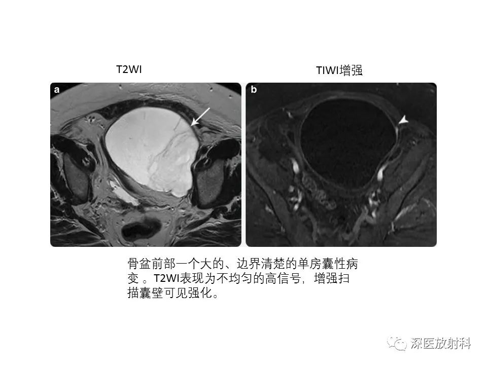 影像PPT - 【PPT】原发性腹膜后囊性病变影像学特征-39