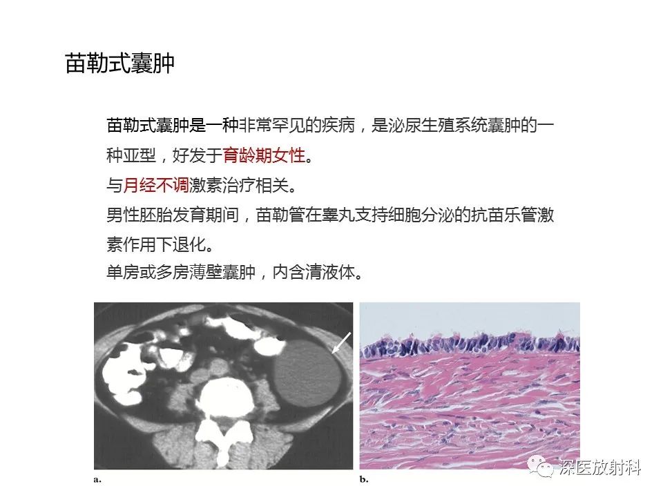 影像PPT - 【PPT】原发性腹膜后囊性病变影像学特征-40