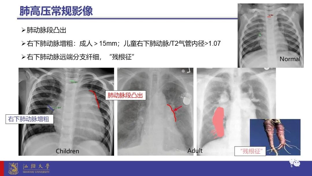 影像PPT - 【PPT】肺血管疾病-6