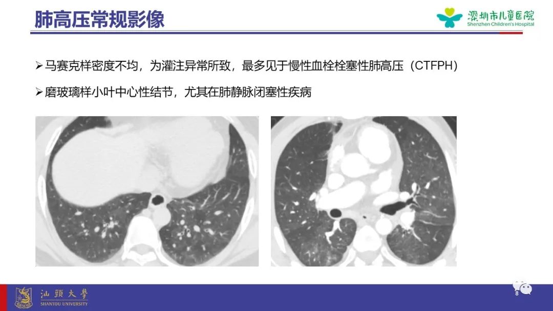 影像PPT - 【PPT】肺血管疾病-8