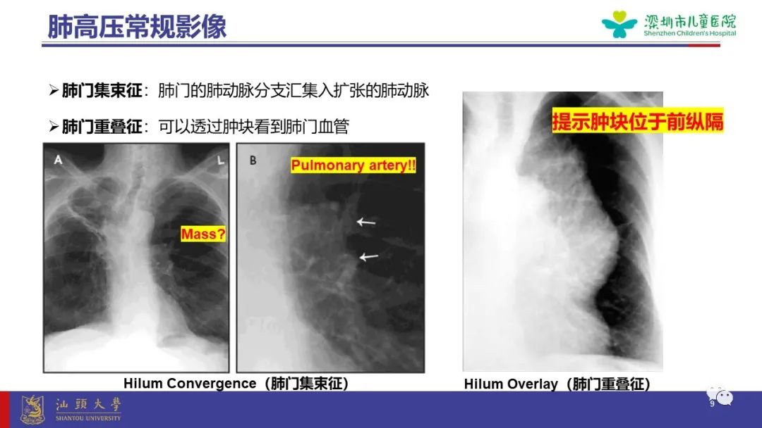 影像PPT - 【PPT】肺血管疾病-9