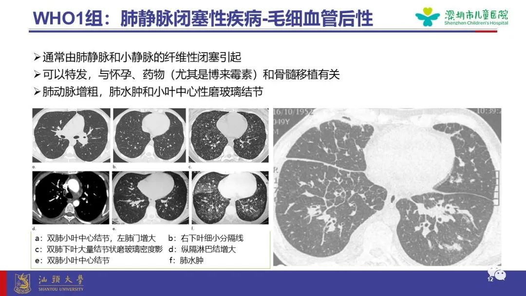 影像PPT - 【PPT】肺血管疾病-12