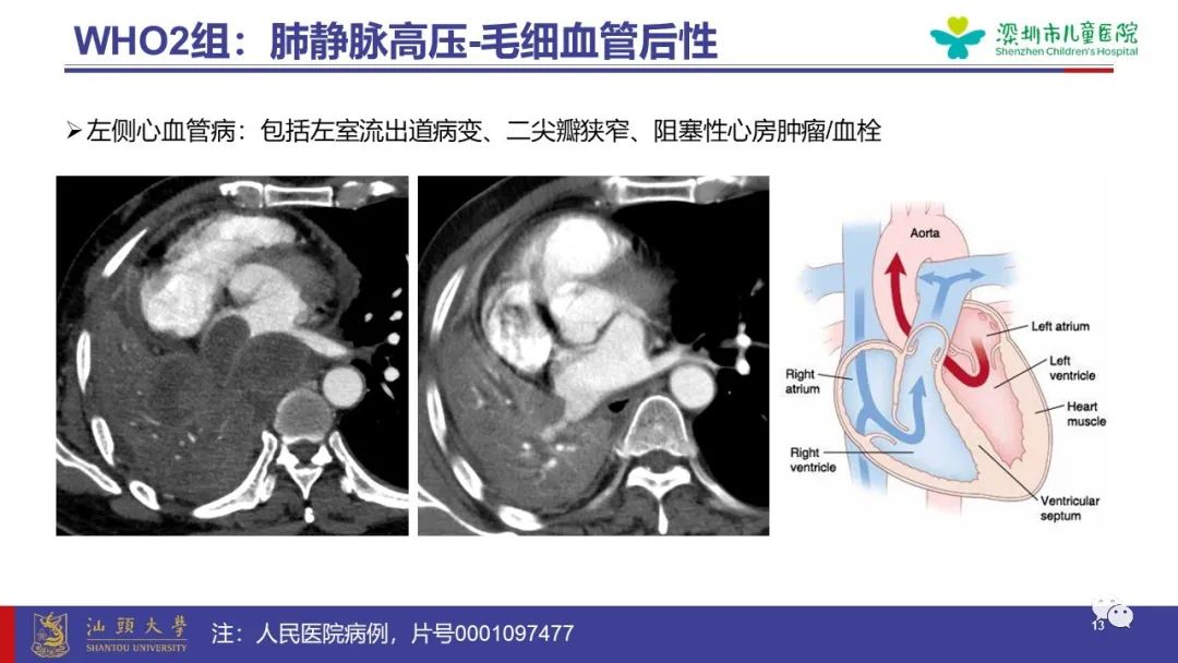 影像PPT - 【PPT】肺血管疾病-13