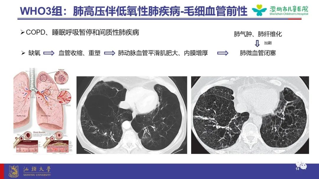 影像PPT - 【PPT】肺血管疾病-14