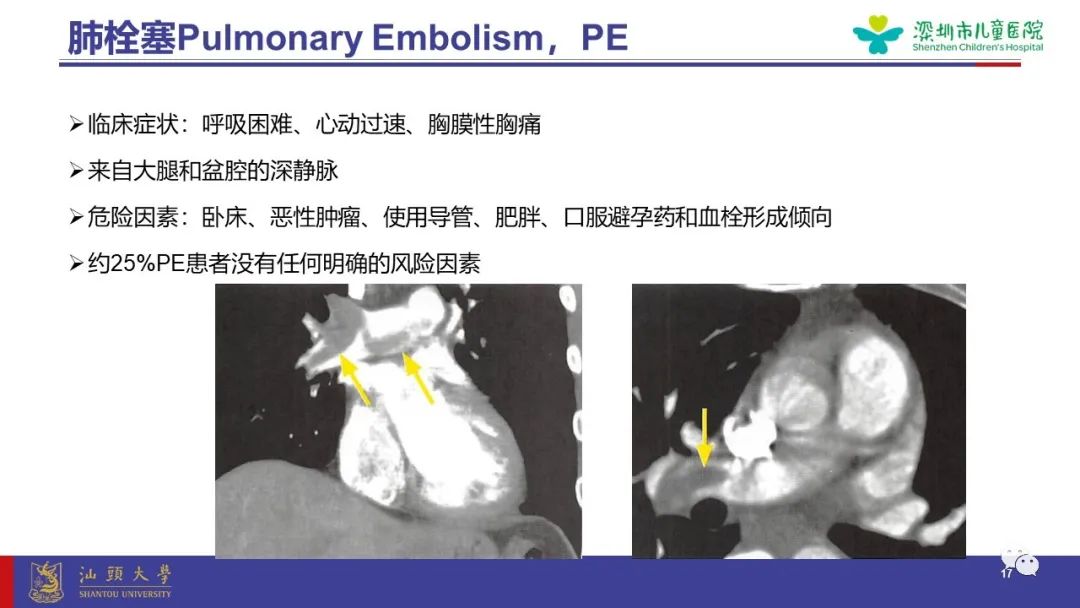 影像PPT - 【PPT】肺血管疾病-17