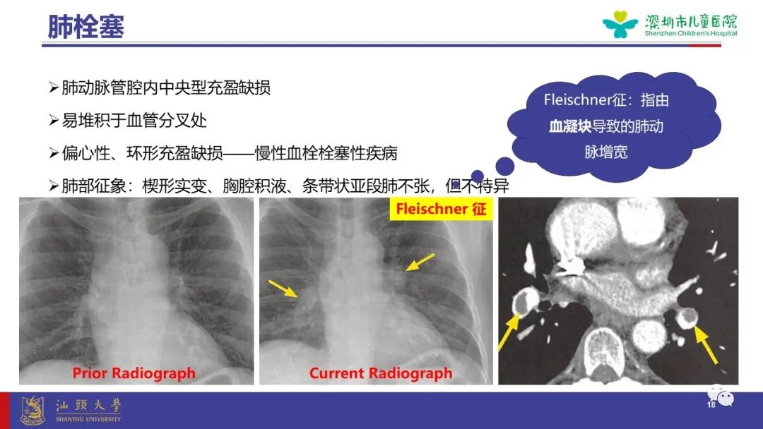 影像PPT - 【PPT】肺血管疾病-18